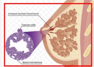 유방암 뜻과 구조 증상 알아보기