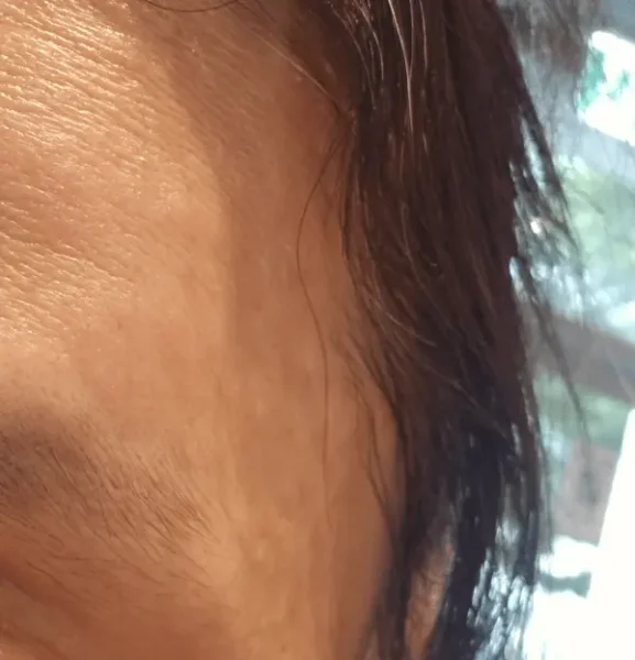 접촉성 피부염 치료 후기 원인, 증상, 병원 치료까지 경험담 정리